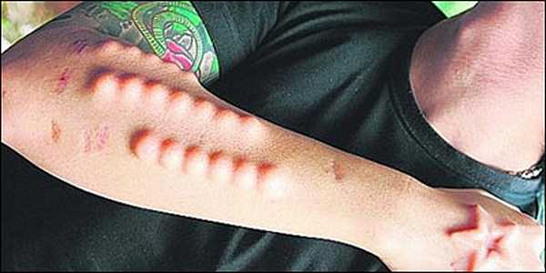 implant17