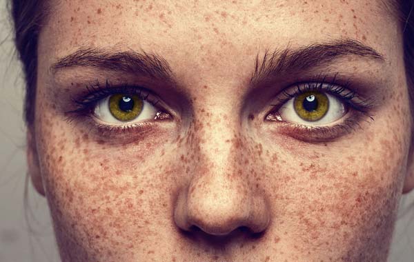 Die Pigmentation der Haut nach der Brandwunde